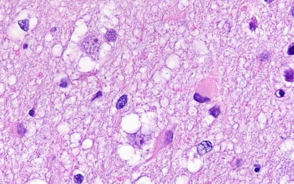 3B9 MVNT (Case 3) H&E 100X 1