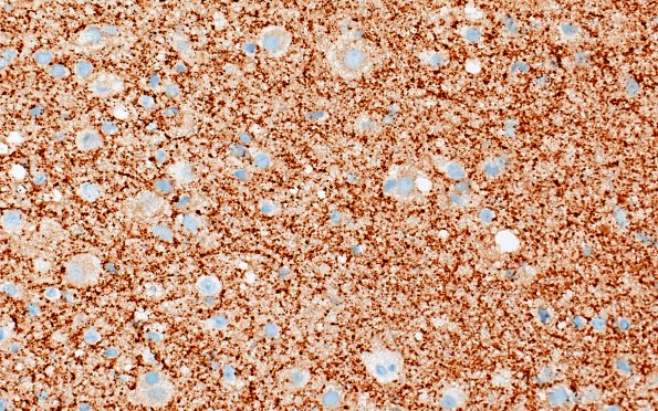 3C2 MVNT (Case 3) B6 SYN 40X 1