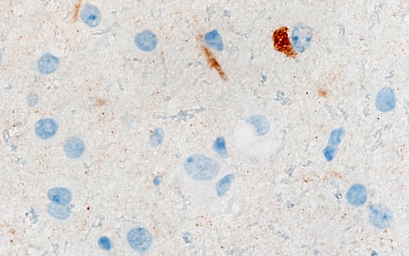 3D1 MVNT (Case 3) B6 NeuN 100X 2