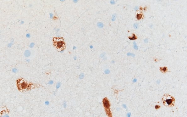 3D2A MVNT (Case 3) B6 NeuN 40X 3