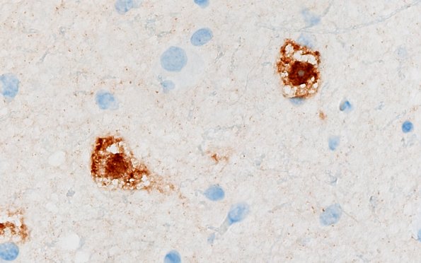 3D2B MVNT (Case 3) B6 NeuN 100X 6