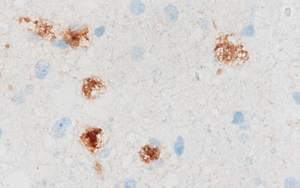 3D3 MVNT (Case 3) B6 NeuN 100X 3