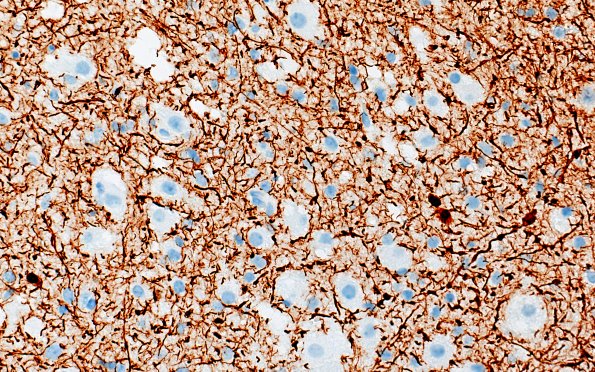 3E1 MVNT (Case 3) B6 NF 40X 3