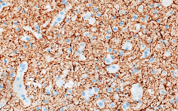 3E2 MVNT (Case 3) B6 NF 40X 6