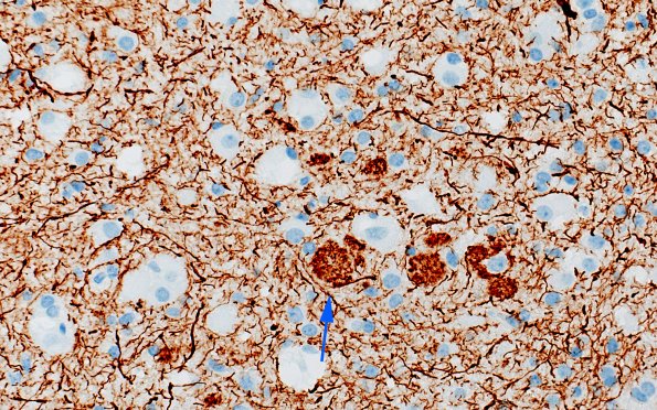 3E3 MVNT (Case 3) B6 NF 40X 5 copy