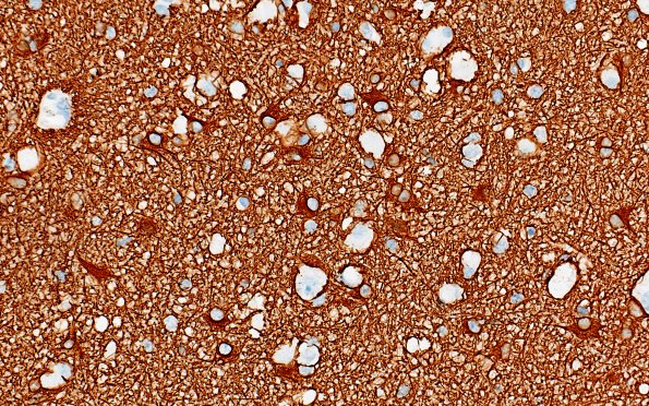 3F1 MVNT (Case 3) B6 GFAP 20X 3