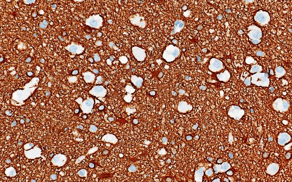 3F2 MVNT (Case 3) B6 GFAP 40X 1