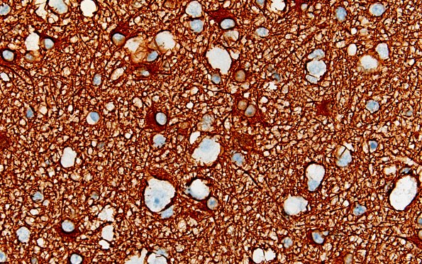 3F3 MVNT (Case 3) B6 GFAP 40X 3