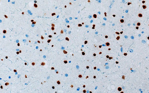 3G1 MVNT (Case 3) B6 Olig2 40X 1A