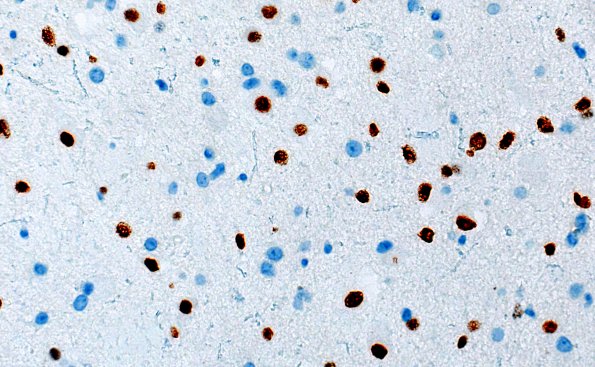 3G2 MVNT (Case 3) B6 Olig2 40X 2A