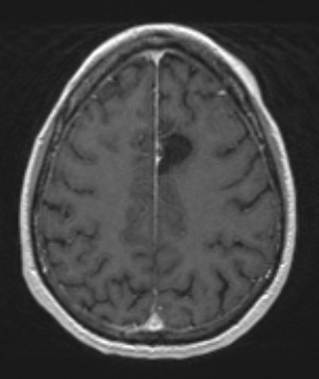 1A3 PGNT) (Case 1) T1W - Copy