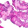 1B1 Papillary Glioneuronal Tumor (PGNT) (Case 1) H&E 5