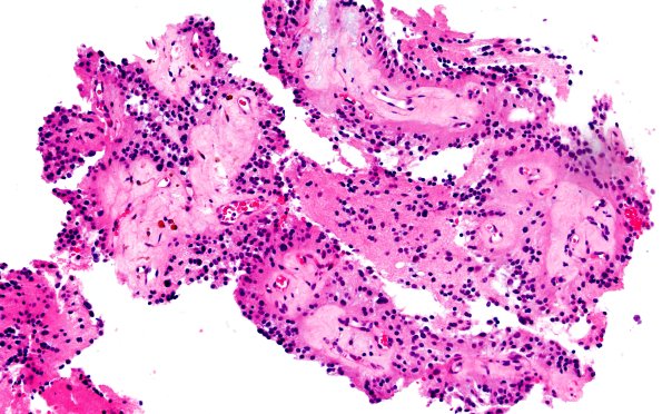 1B1 Papillary Glioneuronal Tumor (PGNT) (Case 1) H&E 5