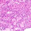 1B2 Papillary Glioneuronal Tumor (PGNT) (Case 1) H&E 4