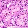 1B3 Papillary Glioneuronal Tumor (PGNT) (Case 1) H&E 3