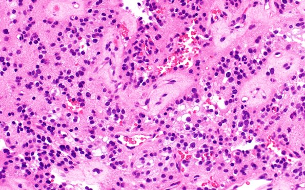 1B4 Papillary Glioneuronal Tumor (PGNT) (Case 1) H&E 2