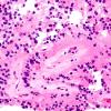 1B5 Papillary Glioneuronal Tumor (PGNT) (Case 1) H&E 7