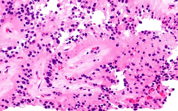 1B5 Papillary Glioneuronal Tumor (PGNT) (Case 1) H&E 7