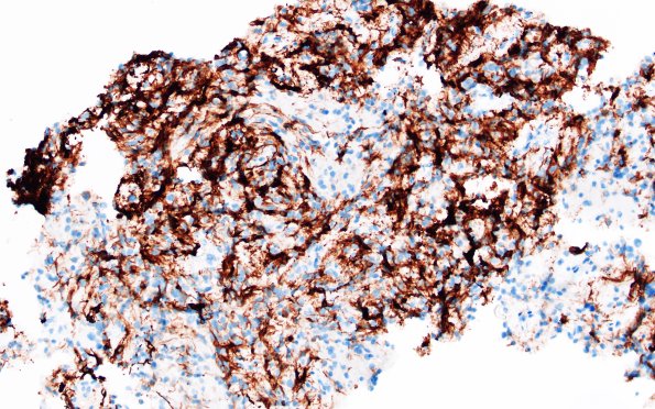 1C1 Papillary Glioneuronal Tumor (PGNT) (Case 1) GFAP 2