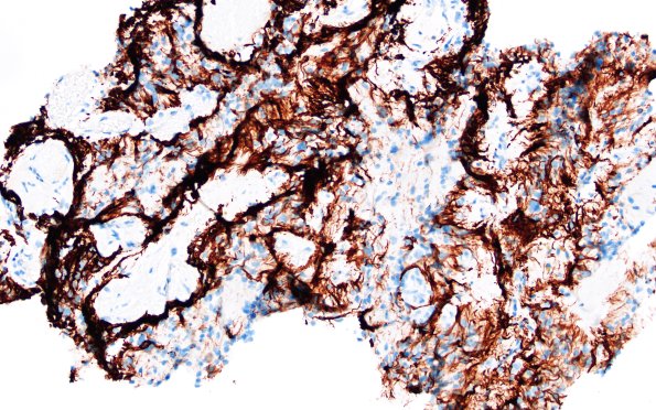 1C2 Papillary Glioneuronal Tumor (PGNT) (Case 1) GFAP 3