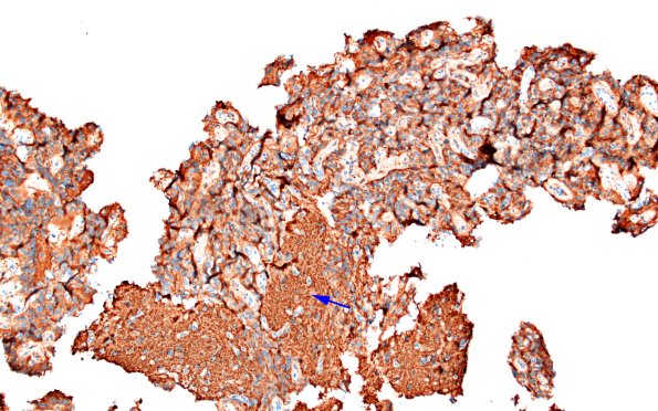 1E1 Papillary Glioneuronal Tumor (PGNT) (Case 1) SYN 5 copy