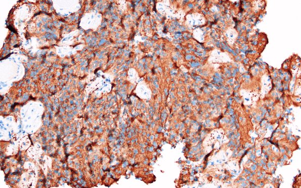 1E2 Papillary Glioneuronal Tumor (PGNT) (Case 1) SYN 1