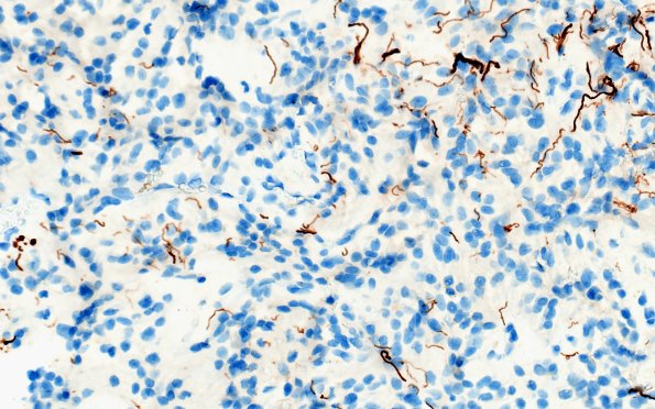 1F2 Papillary Glioneuronal Tumor (PGNT) (Case 1) NF 3