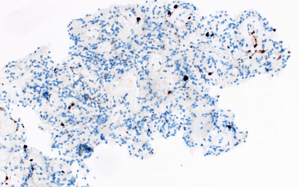 1I Papillary Glioneuronal Tumor (PGNT) (Case 1) Ki67 1