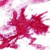 2A1 Papillary Glioneuronal Tumor (PGNT, Case 2) smear 4.jpg