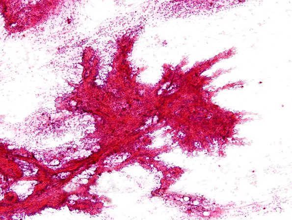 2A1 Papillary Glioneuronal Tumor (PGNT, Case 2) smear 4.jpg