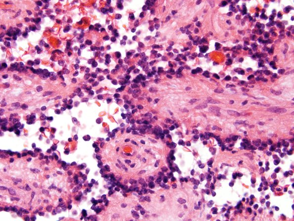 2A10 Papillary Glioneuronal Tumor (PGNT, Case 2) H&E 39.jpg