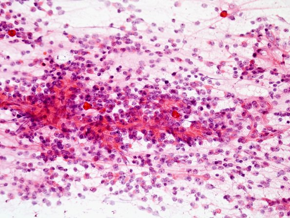 2A2 Papillary Glioneuronal Tumor (PGNT, Case 2) smear 8.jpg