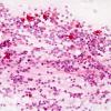 2A3 Papillary Glioneuronal Tumor (PGNT, Case 2) smear 6.jpg