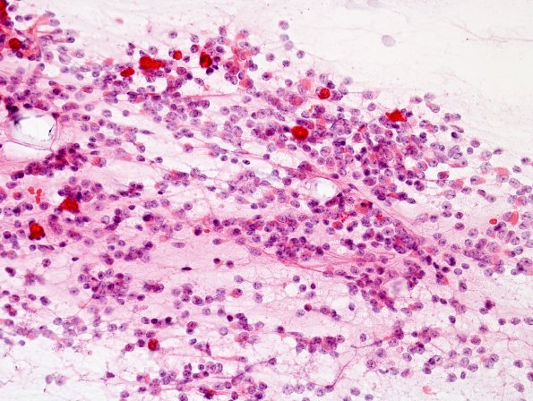 2A3 Papillary Glioneuronal Tumor (PGNT, Case 2) smear 6.jpg