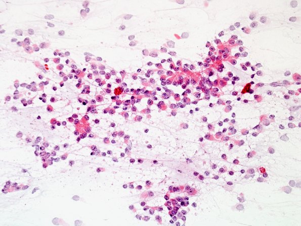 2A4 Papillary Glioneuronal Tumor (PGNT, Case 2) smear 3.jpg