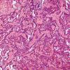 2A5 Papillary Glioneuronal Tumor (PGNT, Case 2) H&E 8.jpg