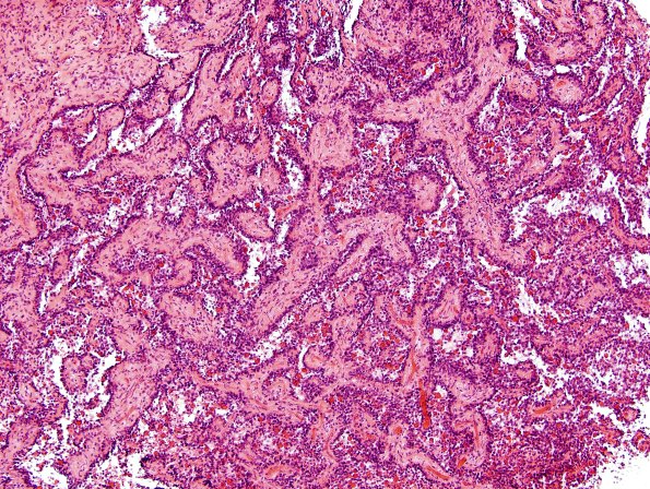 2A5 Papillary Glioneuronal Tumor (PGNT, Case 2) H&E 8.jpg