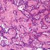 2A6 Papillary Glioneuronal Tumor (PGNT, Case 2) H&E 7.jpg