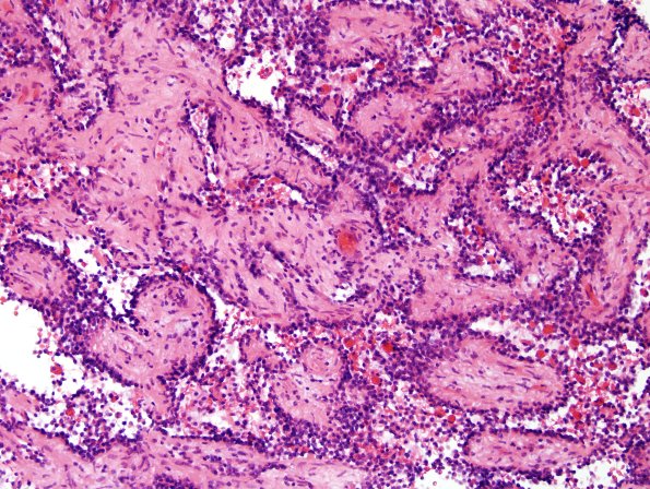 2A6 Papillary Glioneuronal Tumor (PGNT, Case 2) H&E 7.jpg