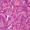 Papillary Glioneuronal Tumor (PGNT)