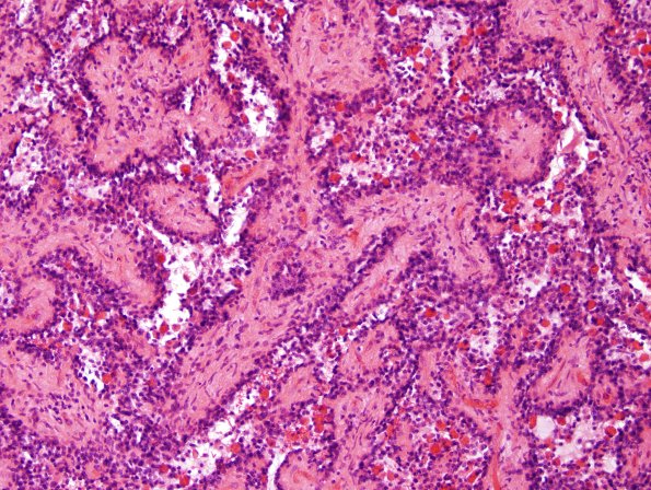 2A7 Papillary Glioneuronal Tumor (PGNT, Case 2) H&E 9.jpg