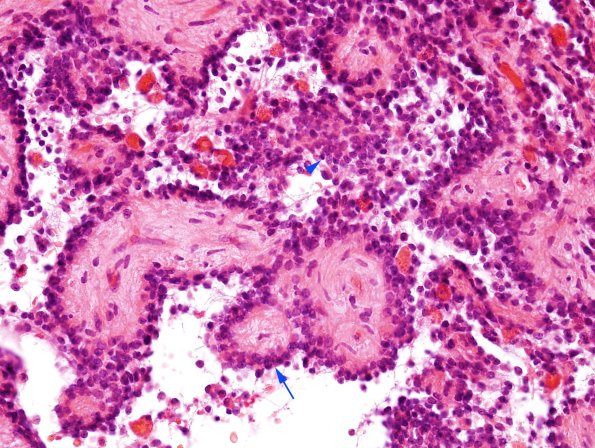 2A8 Papillary Glioneuronal Tumor (PGNT, Case 2) H&E 2 copy