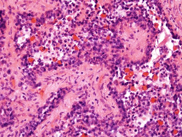 2A9 Papillary Glioneuronal Tumor (PGNT, Case 2) H&E 10.jpg