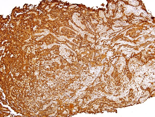 2B1 Papillary Glioneuronal Tumor (PGNT, Case 2) GFAP 1.jpg