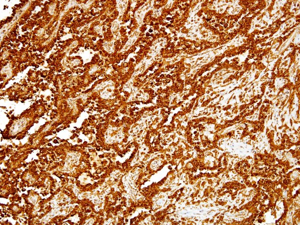 2B2 Papillary Glioneuronal Tumor (PGNT, Case 2) GFAP 2.jpg