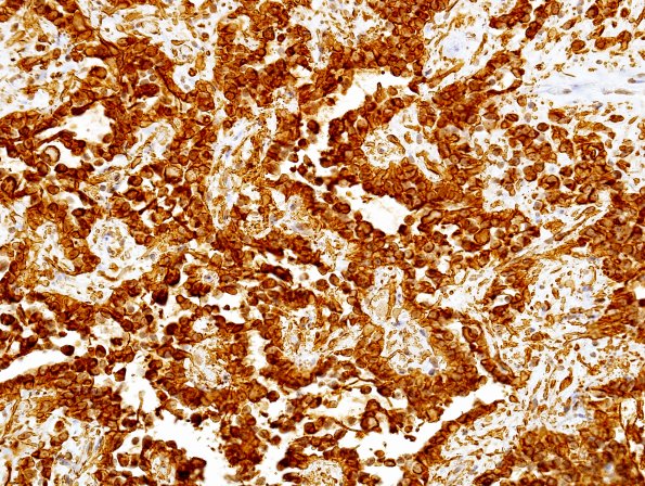 2B4 Papillary Glioneuronal Tumor (PGNT, Case 2) GFAP 8.jpg