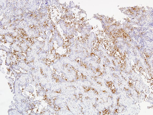 2C1 Papillary Glioneuronal Tumor (PGNT, Case 2) SYN 8.jpg