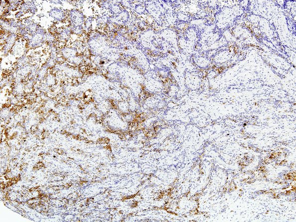 2C2 Papillary Glioneuronal Tumor (PGNT, Case 2) SYN 12.jpg