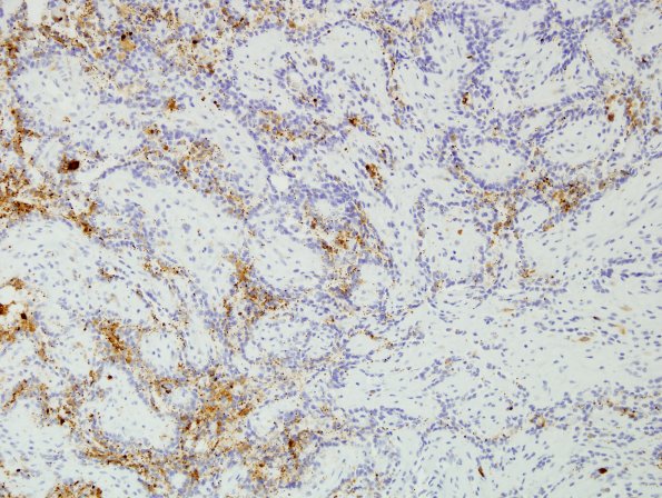 2C3 Papillary Glioneuronal Tumor (PGNT, Case 2) SYN 10.jpg