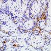 2C4 Papillary Glioneuronal Tumor (PGNT, Case 2) SYN 3.jpg